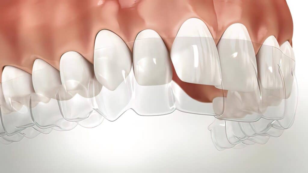 3D illustration of a clear aligner being placed over teeth, showing its contact with gums during orthodontic treatment.
